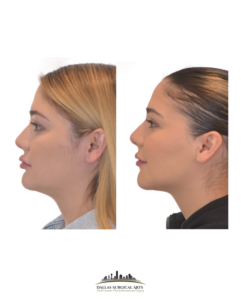 Dallas Genioplasty Cosmetic Surgeon Dr Randy Sanovich Dallas Surgical Arts