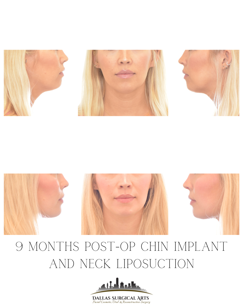 Dallas Genioplasty Cosmetic Surgeon Dr Randy Sanovich Dallas Surgical Arts