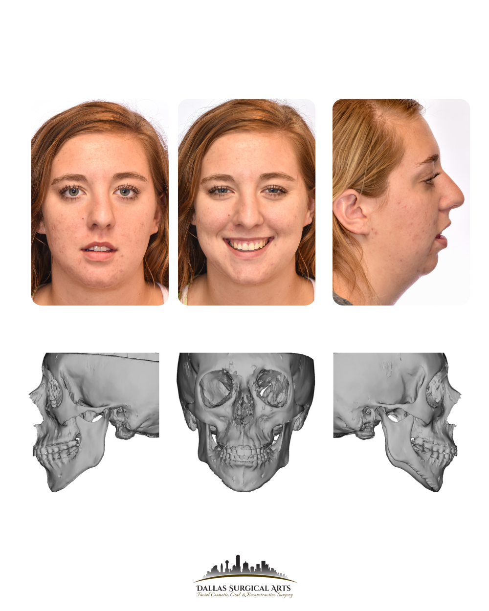 Dallas Genioplasty Cosmetic Surgeon Dr Randy Sanovich Dallas Surgical Arts
