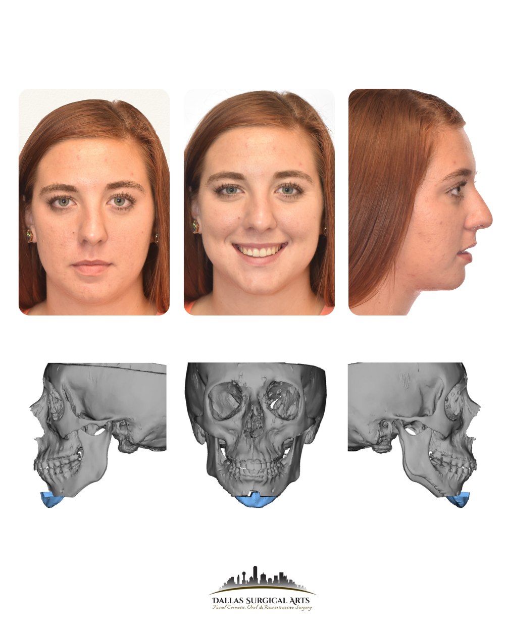 Dallas Genioplasty Cosmetic Surgeon Dr Randy Sanovich Dallas Surgical Arts