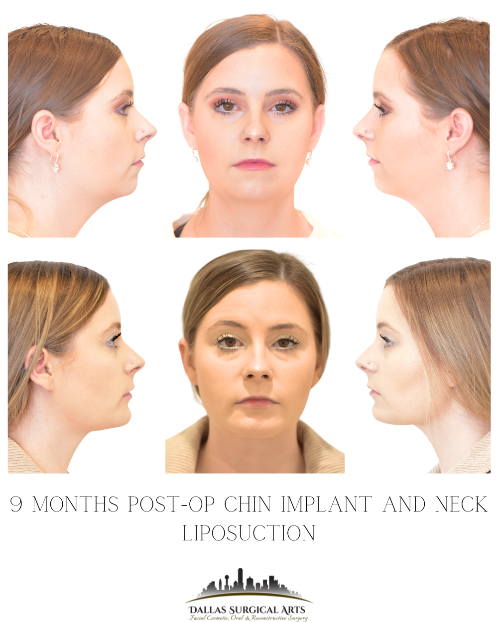 Dallas Genioplasty Cosmetic Surgeon Dr Randy Sanovich Dallas Surgical Arts