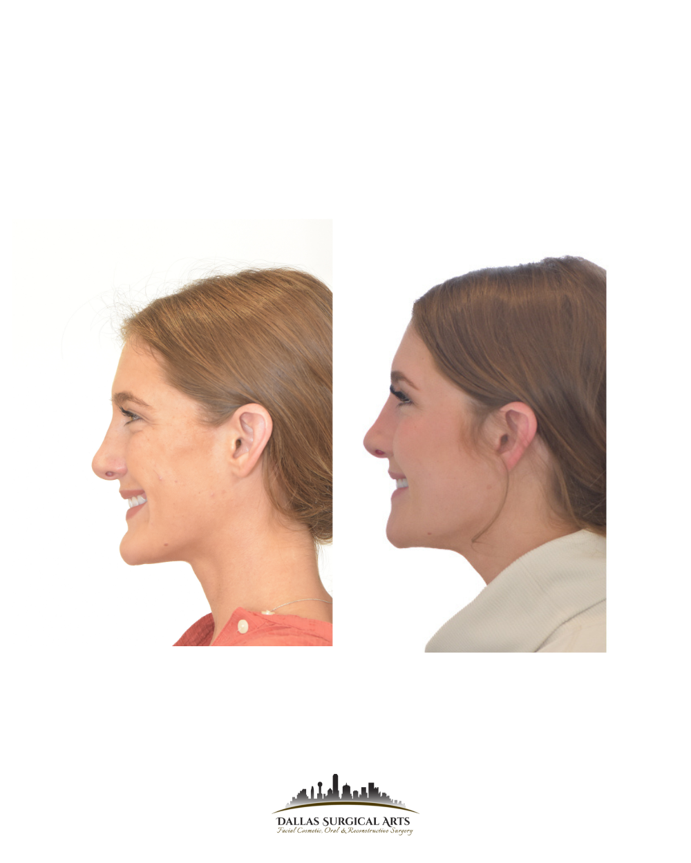 Genioplasty at Dallas Surgical Arts with Dr Randy Sanovich