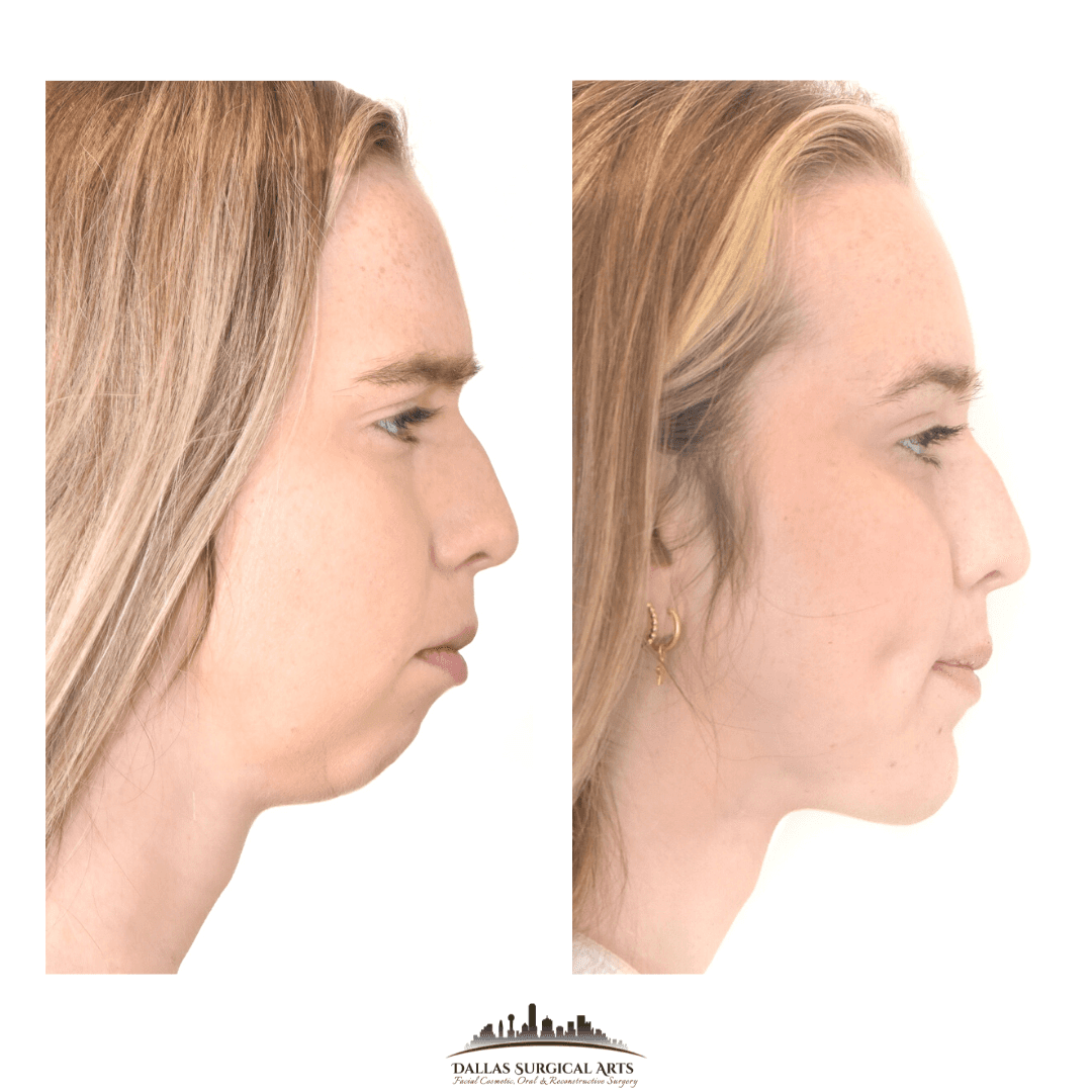 Genioplasty Dallas Chin Surgery Dr Randy Sanovich Dallas Surgical Arts Cosmetic Surgeon