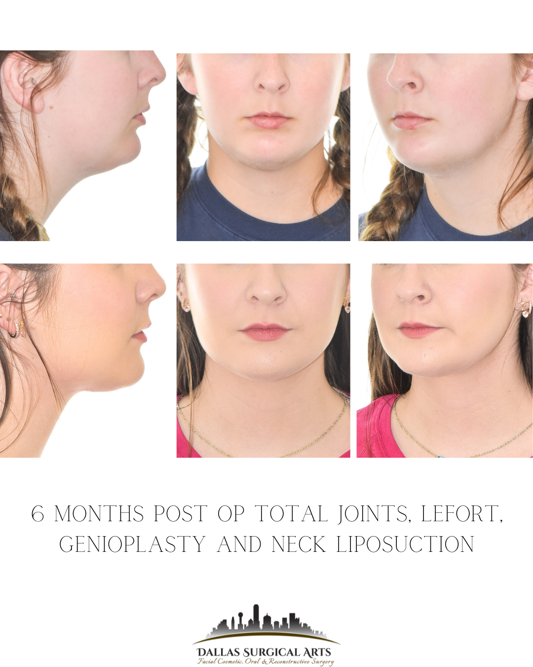 Genioplasty Dallas Chin Surgery Dr Randy Sanovich Dallas Surgical Arts Cosmetic Surgeon